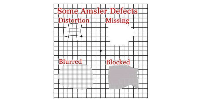 how to use an Amsler grid